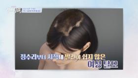 정수리에서 시작되어 발견이 어려운 여성 탈모! 치료도 쉽지 않다...? | JTBC 240226 방송