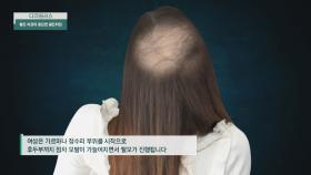 눈에 잘 보이지 않아 초기에 발견하기 힘든 여성 탈모⋯😥 | JTBC 240407 방송