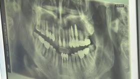 [대구] 대구시, 버려지던 치아로 임플란트용 골이식재 개발 추진