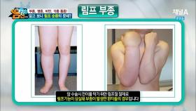 부종, 비만 등… 알고 보니 림프 손상이 문제!