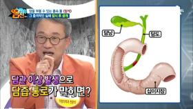 암을 부르는 내 몸속 ‘담석’의 정체! 대체 왜 생기는 걸까?