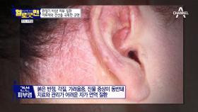 환절기 비상! ‘피부질환’ 아토피와 건선 피부염을 극복한 굿맨의 비법!