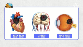 내 몸 속 '염증'을 만드는 '인슐린'! 혈관을 따라 온 몸의 장기를 망가트린다!!