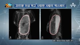 ※충격※ 한국형 위암의 원인 '과식과 폭식'! '내 위도 터질 수 있다'