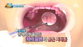 깔끔하게 사라진 치태! 입속 세균 잡는 배건치스틱 효과는?!