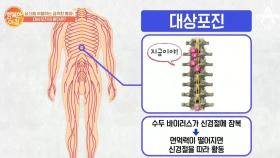 대상포진의 원인 '수두 바이러스' 면역력이 떨어지면 다시 재발한다?!