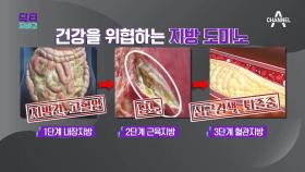 지방, 여기에 쌓이면 위험하다! 질병 유발하는 3단계 지방 도미노!