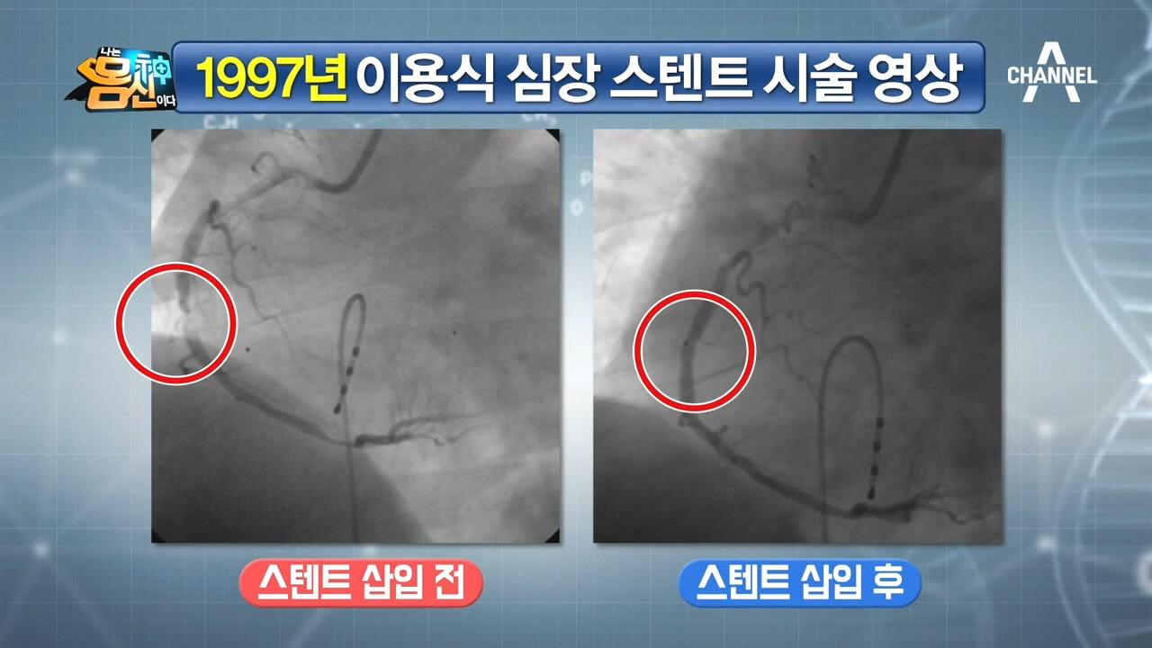 심근경색 발병 당시 이용식의 심장 상태는 스텐트 시술 영상 전격 공개 Zum Tv 3858