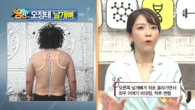 거북 목과 굽은 등의 원인이 되는 죽은 날개뼈! 몸신 가족의 날개뼈 상태는?