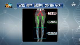 골반, 허벅지, 종아리 동맥에 생기는 말초 동맥 질환의 원인은 각각 다르다?!