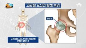 X-ray, MRI로도 발견하기 힘들다?! 방치하기 쉬운 고관절 오십견