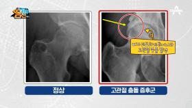 [고관절 질환] 움직일 때마다 통증을 느끼는 고관절 충돌 증후군!