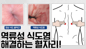 끔찍한 통증 '역류성 식도염'! 누를수록 좋아지는 혈자리!