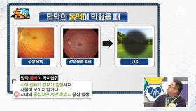 실명을 부르는 시그널 한쪽 눈의 시력이 저하되는 '망막 혈관 폐쇄증'