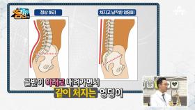 힘없이 처진 엉덩이의 원인은 사라진 허리 곡선, 일자 허리다?!