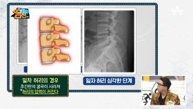 사라진 허리 라인의 습격! 체형 불균형의 원인인 일자 허리