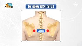 [굽은 등 압통점 테스트] 숨어 있는 등 부위 통증 확인하기!