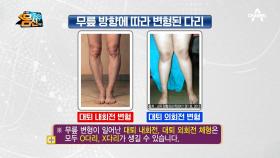 퇴행성 관절염 부르는 O다리, X다리 교정하는 방법은?