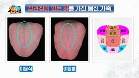 ＊혀가 보내는 면역력 저하 시그널＊ 