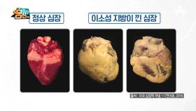 장기를 위협하는 제3의 지방! '이소성 지방'이란?