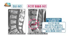 ※필라테스로 허리 통증 극복※ 척추의 추간판 탈출증이란?!