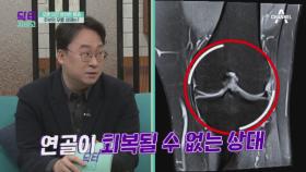 관절 간격이 줄어들기 시작한 주인공의 무릎 상태, 관절염을 막아라!