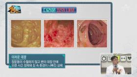 더러운 장이 건강을 망친다! 대장암을 유발하는 '더러운 장'