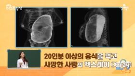 폭풍 같이 몰려오는 식욕, 20인분 이상 먹고 사망한 사람의 X-ray 사진