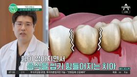 감기만큼 흔한 치주질환! 치아와 잇몸 관리는 미리 해야 합니다 #치주질환