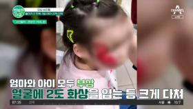 포천 테마파크 깡통열차 뒤집혀 3살 아이 얼굴 갈리고 2도 화상 #깡통열차사고