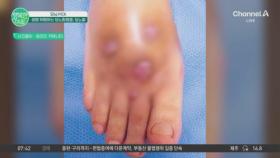 당뇨병 환자 600백만명 넘어