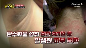 [예고] 탄수화물 섭취 중단 90일 이후 발생한 피부 질환!? 다이어트 성공과 피부 건강까지 지킨 비법은?