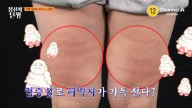 [예고] 병든 지방과 염증살이 내 몸에? 셀룰라이트 없애는 ★셀 제거 프로젝트★