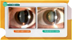 [닥터 상담소] 눈에 안개가 낀 것 같아요. 백내장의 모든것