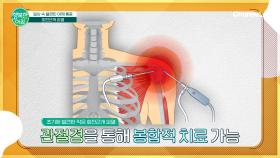 [닥터 상담소] 일상속 극심한 어깨 통증을 유발하는 회전근개파열