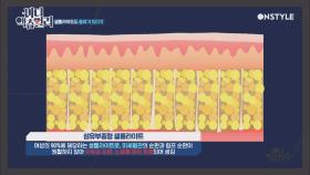 지방형 셀룰라이트 VS 부종형 셀룰라이트