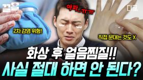 화상 후 얼음찜질은 위험하다?!😲 우리가 오해했던 생활 속 지식.zip | 프리한19