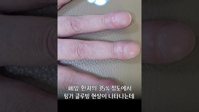 손가락으로 폐암을 알 수 있다? 