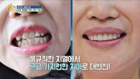 [당신은 꽃입니다] 불규칙적인 치아에서 가지런한 치아로 大 변신