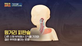 [노마병] 낙후된 의료 환경에 적합한 수술 '원거리 피판술'