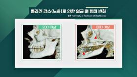 (속상) 콜라겐 감소로 인해 변하는 얼굴뼈 형태ㅠ_ㅠ | JTBC 200927 방송