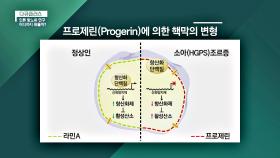 [소아 조로증] 급속한 노화를 부르는 독성 단백질 '프로제린' | JTBC 201101 방송