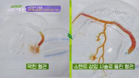 막힌 혈관을 뻥↗ 심근경색의 치료 방법 = [스텐드 삽입 시술] | JTBC 210501 방송