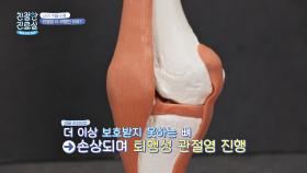 쓸수록 닳고 손상되는 연골 ☞ 퇴행성 관절염 발생 | JTBC 210503 방송