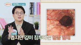 심하면 대장 절제까지?! 장 건강 무너지면 생기는 '크론병' | JTBC 210505 방송