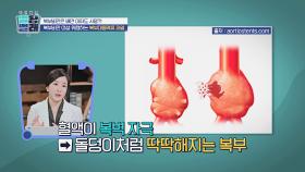 죽음의 시한폭탄💣 복부비만이 부르는 '복부대동맥류 파열' | JTBC 220916 방송