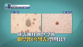 [피부암] 육안으로는 구분이 어려운 흑색종과 일반 점😨 | JTBC 220923 방송