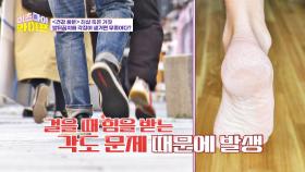 [진실 혹은 거짓] 발뒤꿈치에 각질은 무좀이다?! | JTBC 230308 방송