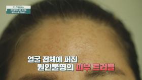 얼굴 전체를 덮은 트러블💥 피부 노화의 주범은 무엇일까? | JTBC 240421 방송