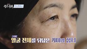 기미와 잡티로 뒤덮인 피부.. 어둠 속에 숨은 주인공의 사연은? | JTBC 240520 방송